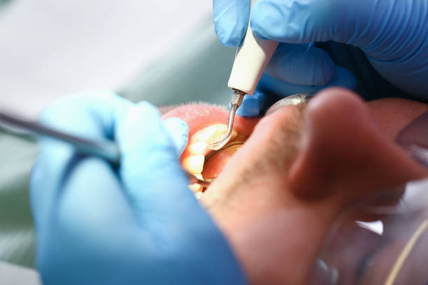 Best Emergency Treatment for Dental Infections or Abscesses in Sleepy Hollow, NY